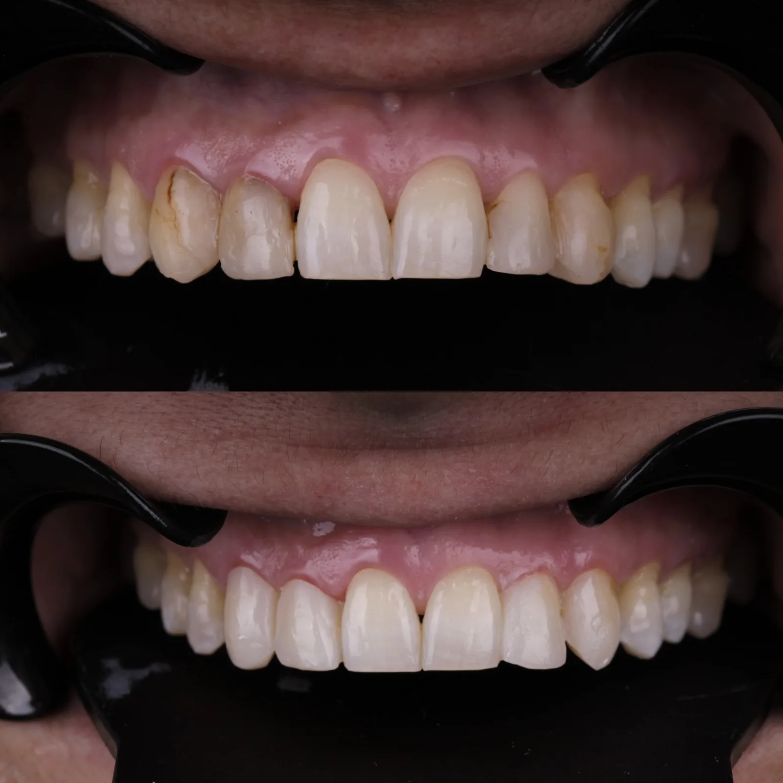 Carillas dentales en Naucalpan: Transforma tu sonrisa con el Dr. Ulises Xavier Diaz Mendoza