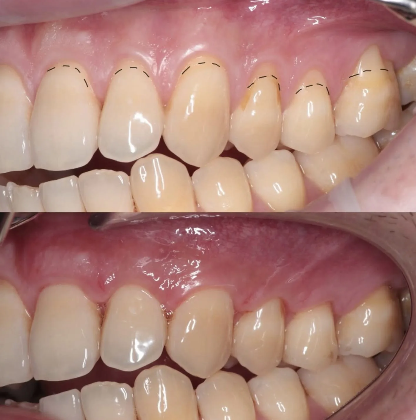 Recupera tu sonrisa con la Cirugía de recubrimiento de raíces en Naucalpan
